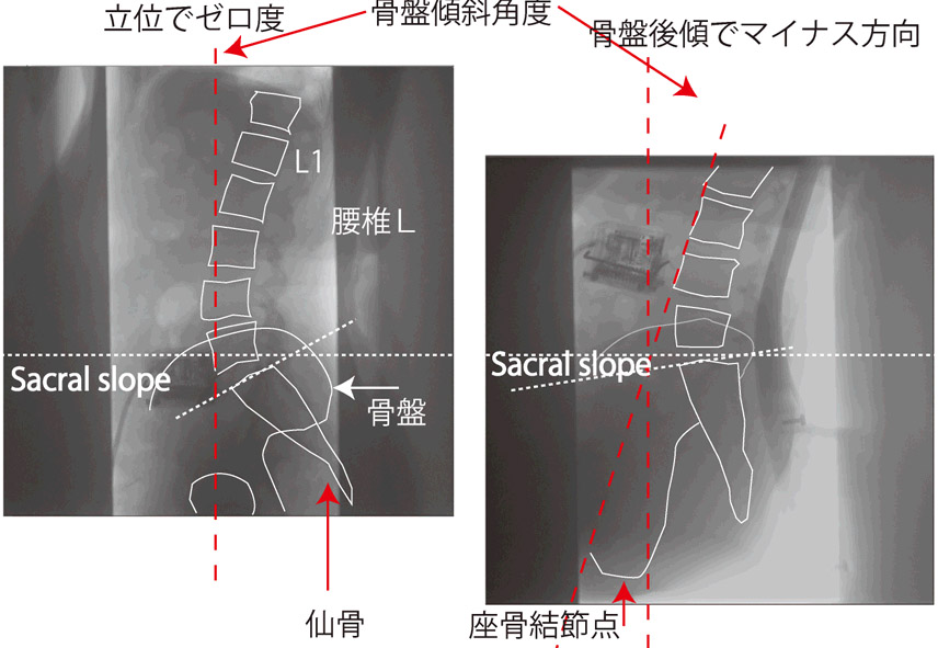 角度計とX線