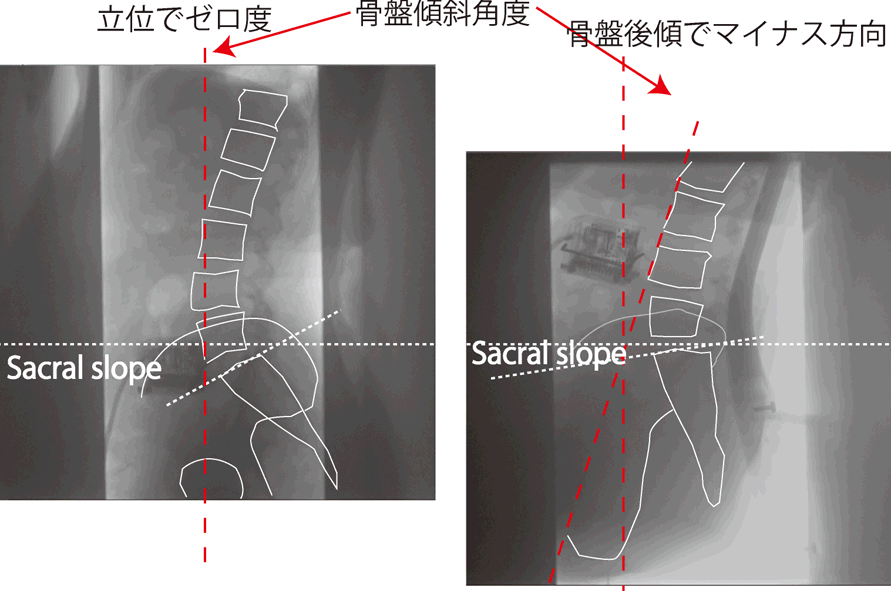 骨盤傾斜角度とSacral slope X線画像版